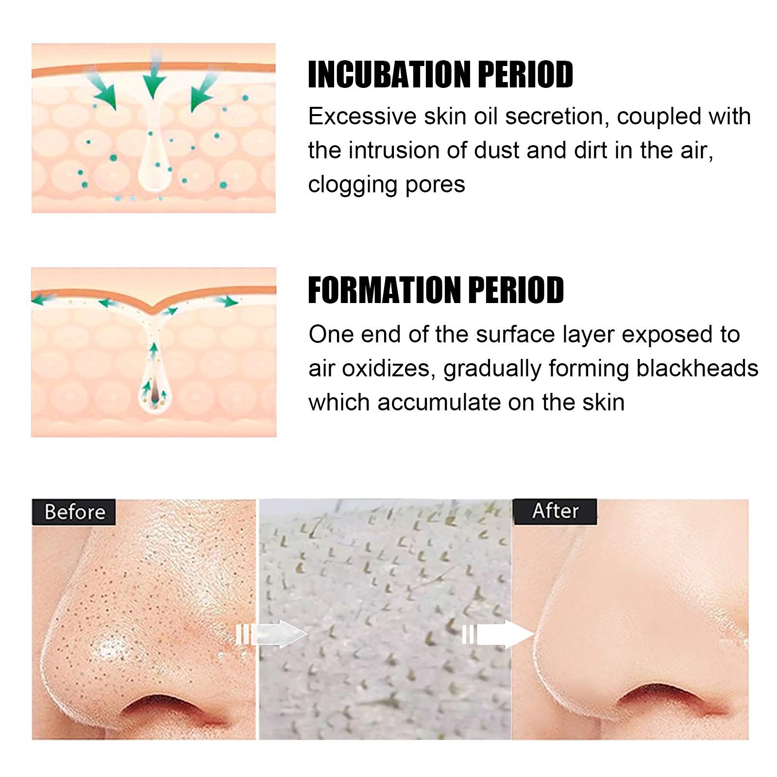 Volumette Complete Pore Kit (Blackhead Cream + 40 Pore Strips) - Image 5